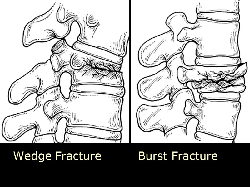 Wedge Fracture  Burst Fracture